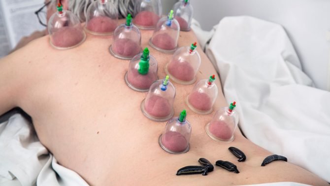 Hacamat Tedavisi ile Alakalı Bilmeniz Gerekenler